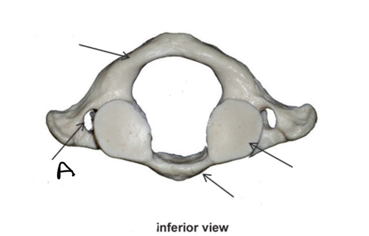 <p>What Vertebra bone is this?</p><p>What is A?</p>