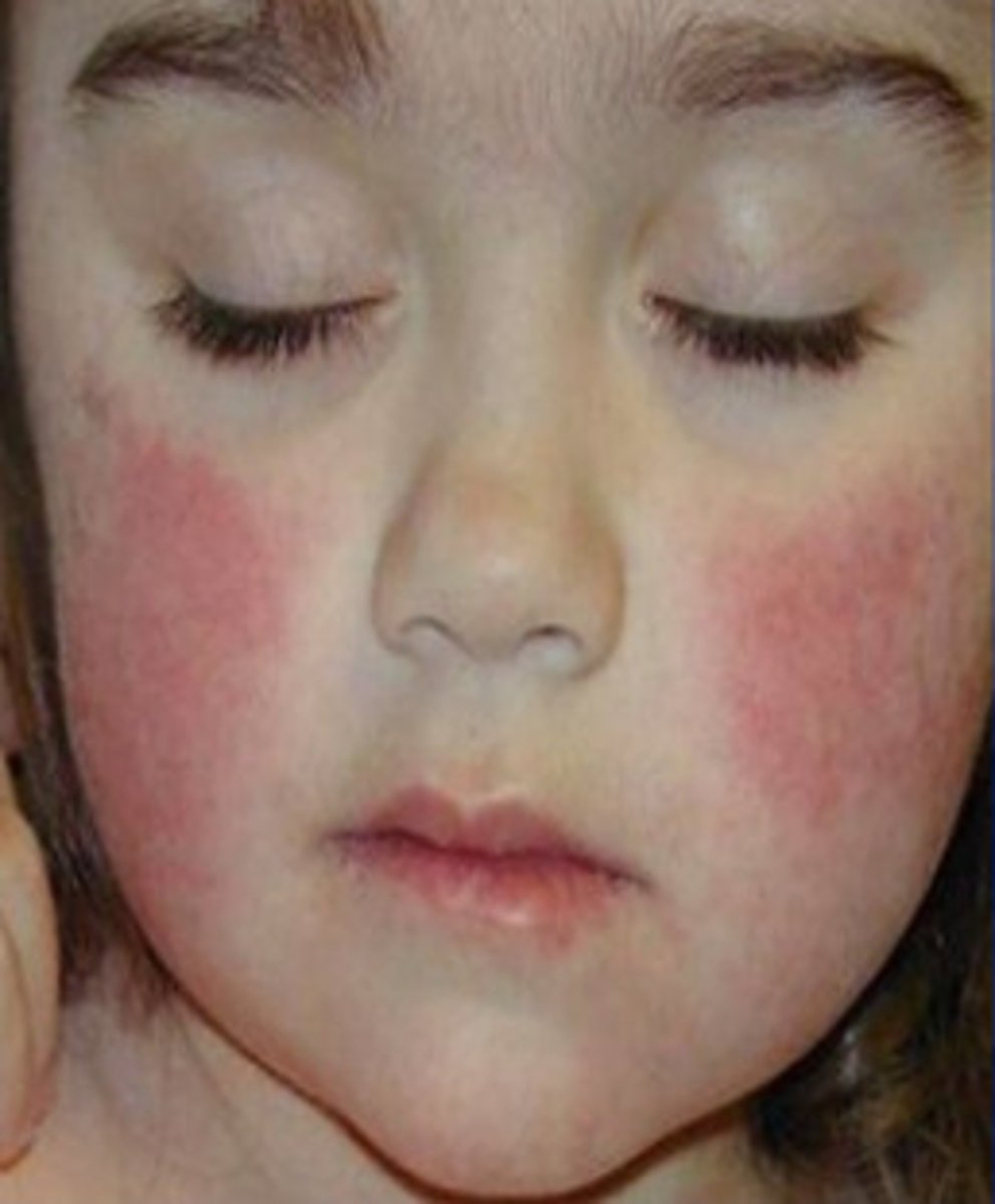 <p>fifth disease "slapped cheek syndrome" which can spread to trunk, arthritis,</p>