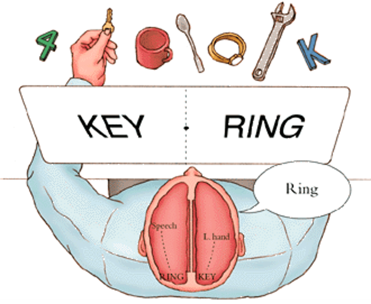 <p>a procedure that involves cutting the main band of nerve tissue (corpus callosum) connecting the two hemispheres</p>