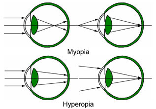 <p>farsightedness, a refractive error where the eye’s focal point is located behind the retina instead of on it.</p>