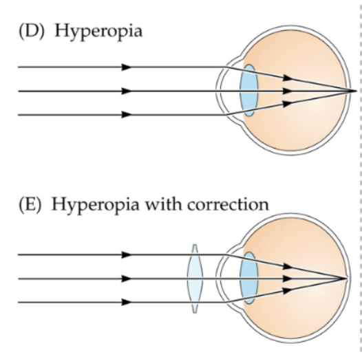 <p><span style="background-color: transparent; font-family: &quot;Times New Roman&quot;, serif;"><span>farsightedness, eyeball too short or optics too weak; distant objects in focus behind retina</span></span></p><ul><li><p><span style="background-color: transparent; font-family: &quot;Times New Roman&quot;, serif;"><span>easier to see distant objects; accommodation brings them into focus on retina</span></span></p></li><li><p><span style="background-color: transparent; font-family: &quot;Times New Roman&quot;, serif;"><span>can’t bring near objects into focus</span></span></p></li><li><p><span style="background-color: transparent; font-family: &quot;Times New Roman&quot;, serif;"><strong><u><span>need positive, convex lens </span></u></strong><span>adds optical power to bring both near &amp; distant objects into focus</span></span></p></li><li><p><span style="background-color: transparent; font-family: &quot;Times New Roman&quot;, serif;"><span>present in most newborns; many become emmetropic as eyeball grows</span></span></p></li></ul><p></p>