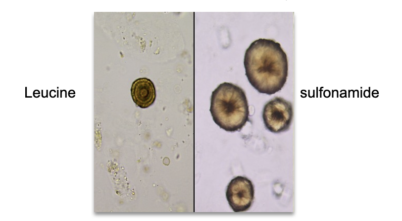 <ul><li><p class=""><strong>Morphology</strong>: Yellow-brown spheroids with concentric rings (outer edge) and radial striations (center)</p></li><li><p class=""><strong>Found in</strong>: Acidic urine</p></li><li><p class=""><strong>Soluble in</strong>: NaOH, hot water</p></li><li><p class=""><strong>Associated Conditions</strong>:</p><ul><li><p class="">Severe liver disorders (e.g. cirrhosis, severe viral hepatitis)</p></li><li><p class="">Maple syrup urine disease</p></li><li><p class="">Amino acid metabolism disorders</p></li></ul></li><li><p class=""><strong>Often seen with</strong>: Tyrosine crystals</p></li><li><p class=""><strong>Bilirubin test</strong>: Positive</p></li><li><p class=""><strong>Pitfall</strong>: May be confused with <span style="color: red">sulfonamide</span> crystals (distinguishable by structure). <span style="color: red">Many antibiotics have sulfonamides in them.  </span><span style="color: #10ee0b">Perform solubility test to distinguish between the two.</span></p><p class=""></p></li></ul><p></p>