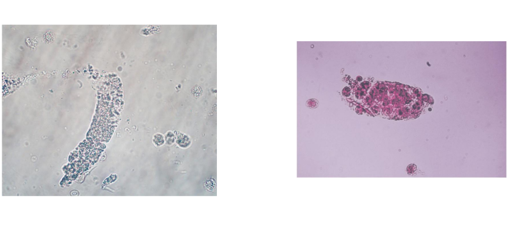 <p><span>WBC casts are seen with infection and</span></p><p><span>inflammation of the nephron</span></p><p></p><p><span>Pyelonephritis: WBC casts, bacteria</span></p><p></p><p><span>Acute interstitial nephtitis: WBC casts, no</span></p><p><span>bacteria</span></p><p></p><p><span>May accompany RBC casts in</span></p><p><span>glomerulonephritis</span></p>
