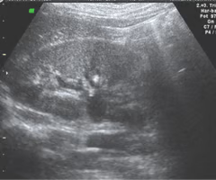 <p>Renal papillary necrosis (RPN) is caused by ___, ___, ___, and other diseases </p>