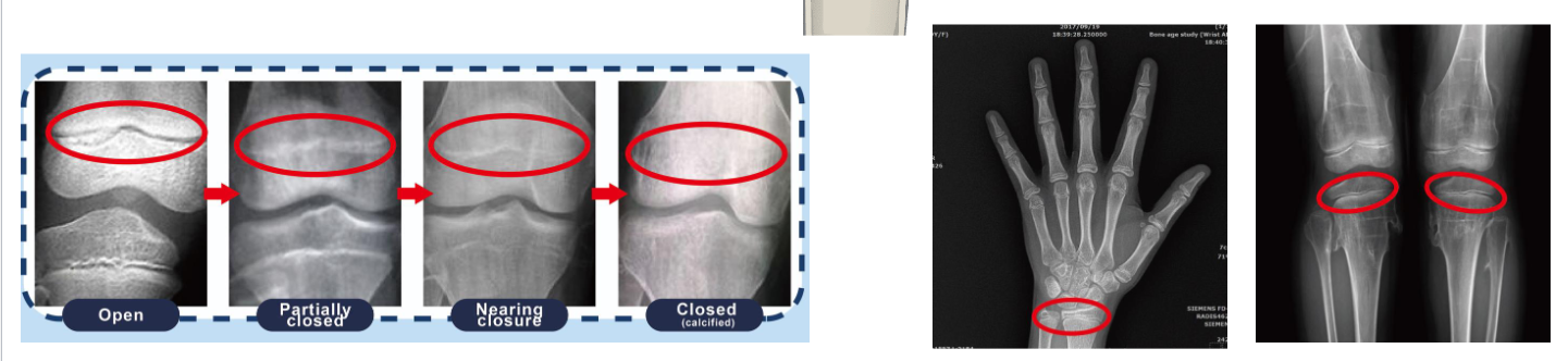 <p>Epiphyseal Plate Closure</p>