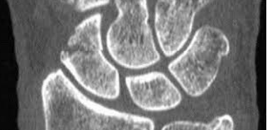 <p>What carpal bone is fractured?</p>