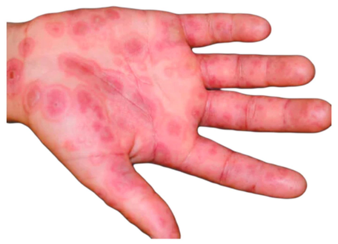 <p>An 8-year-old girl presents to the clinic with her parent for concerns about a rash that started 2 days ago. The rash is located on the patient’s arms, hands, and legs and is not itchy or painful. She also has a rash on her lips, which her parent says started out as a cold sore a week ago. The girl’s vital signs are a blood pressure of 98/64 mm Hg, a heart rate of 96 bpm, a respiratory rate of 18/min, an oxygen saturation of 98%, and a temperature of 99.2°F. Upon physical examination of the skin, there are several erythematous lesions scattered over bilateral arms, hands, and legs. The lesions have a dusky central area surrounded by a pale ring of edema, with erythema on the periphery of the lesions. The lesions on the vermillion and mucosal surfaces of the lips appear similar. The heart exam is within normal limits, and the lungs are clear to auscultation. An ENT examination is unremarkable, and the rest of the physical examination is within normal limits. What is the name of the patient’s suspected condition?</p><p>AErythema marginatum</p><p>BErythema migrans</p><p>CErythema multiforme</p><p>DStevens-Johnson syndrome</p>