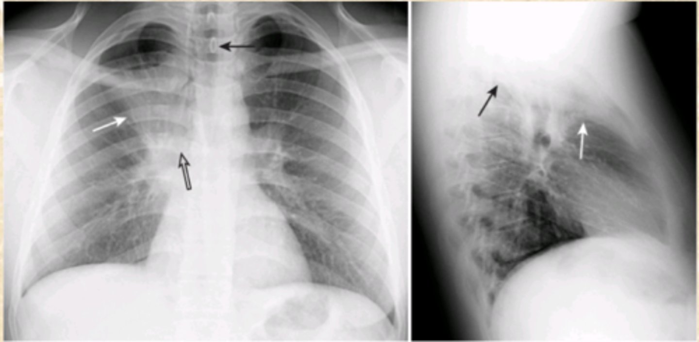 <p>What does this CXR show?</p>