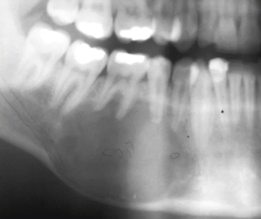 <p>RO/RL well-defined concentric lesion with WIDE zone of transition, causes <strong>ROOT RESORPTION </strong>and <strong>DISPLACES</strong> teeth and <strong>IAC</strong></p>