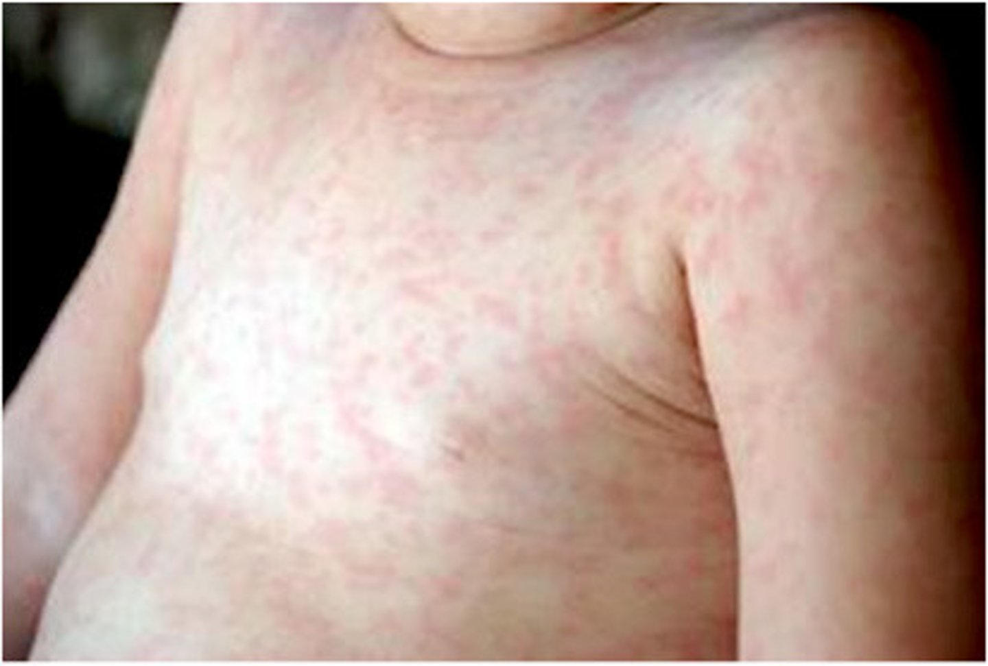 <p>dx: roseola infantum (sixth's disease) caused by human herpes virus 6 or 7 (this is the ONLY childhood exanthem that starts on trunk and spreads to face!)</p><p>tx: supportive, anti-inflammatory, anti-pyretic (to prevent febrile seizures)</p>