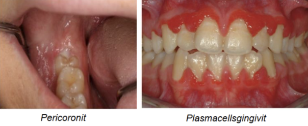 <p>Pericoronit och plasmacellsgingivit</p>