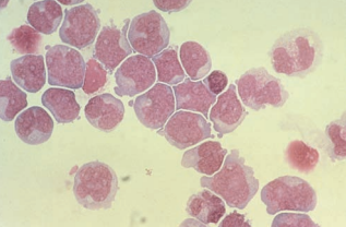 Figure 19: Myeloblasts