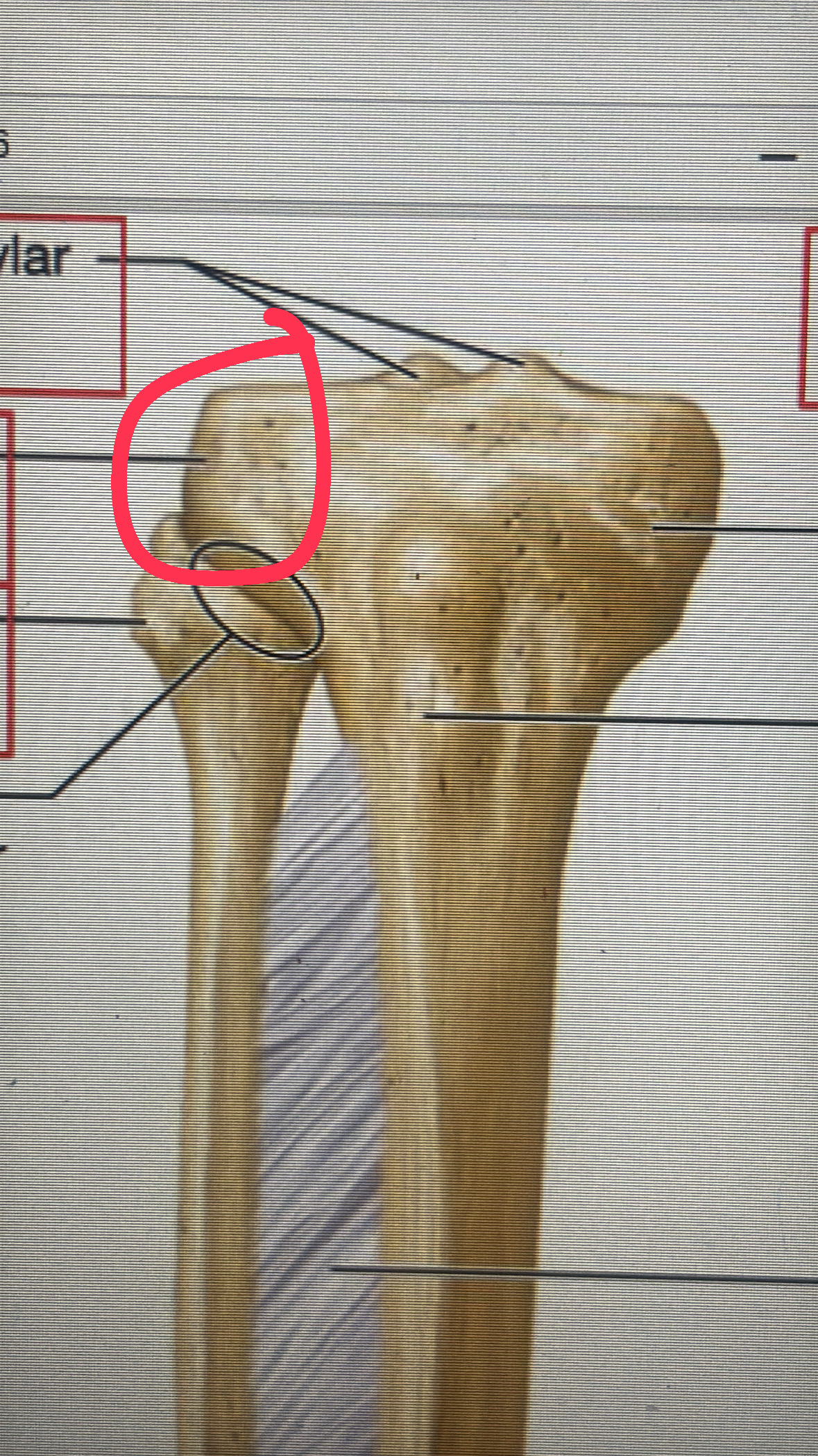 <p>outer bulb of the proximal epiphysis of the tibia</p>