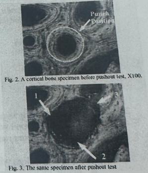 <p>In cortical bone, the tensile failure mechanism has been shown to be mainly one of debonding at _______ and pulling out of _____________ as illustrated here.</p><p>a. Cement lines, osteons</p><p>b. Lacunae, lamellae</p><p>c. Volkmann’s canals, lacunae</p><p>d. Canaliculi, teeth</p>