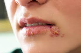 <p>PP: fluid-filled outside/side of face/lips→recurrent+painful eruptions</p><p>E: HSV</p><p>CM: vesicles on lips+surrounding skin<br>painful<br>yellow-brown crust</p><p>P: heal on own (self-limited) x 10-14 days</p>