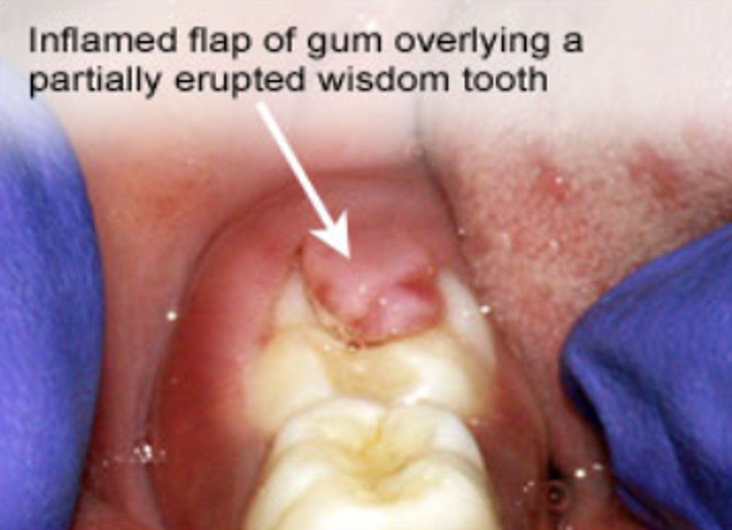 <p>Pain + swelling</p>