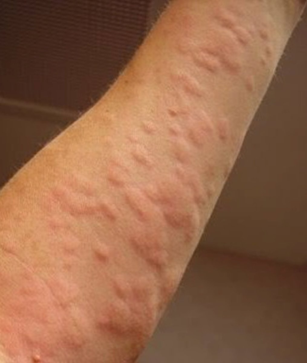 <p>red, itchy, fluid containing papule (hives)</p>