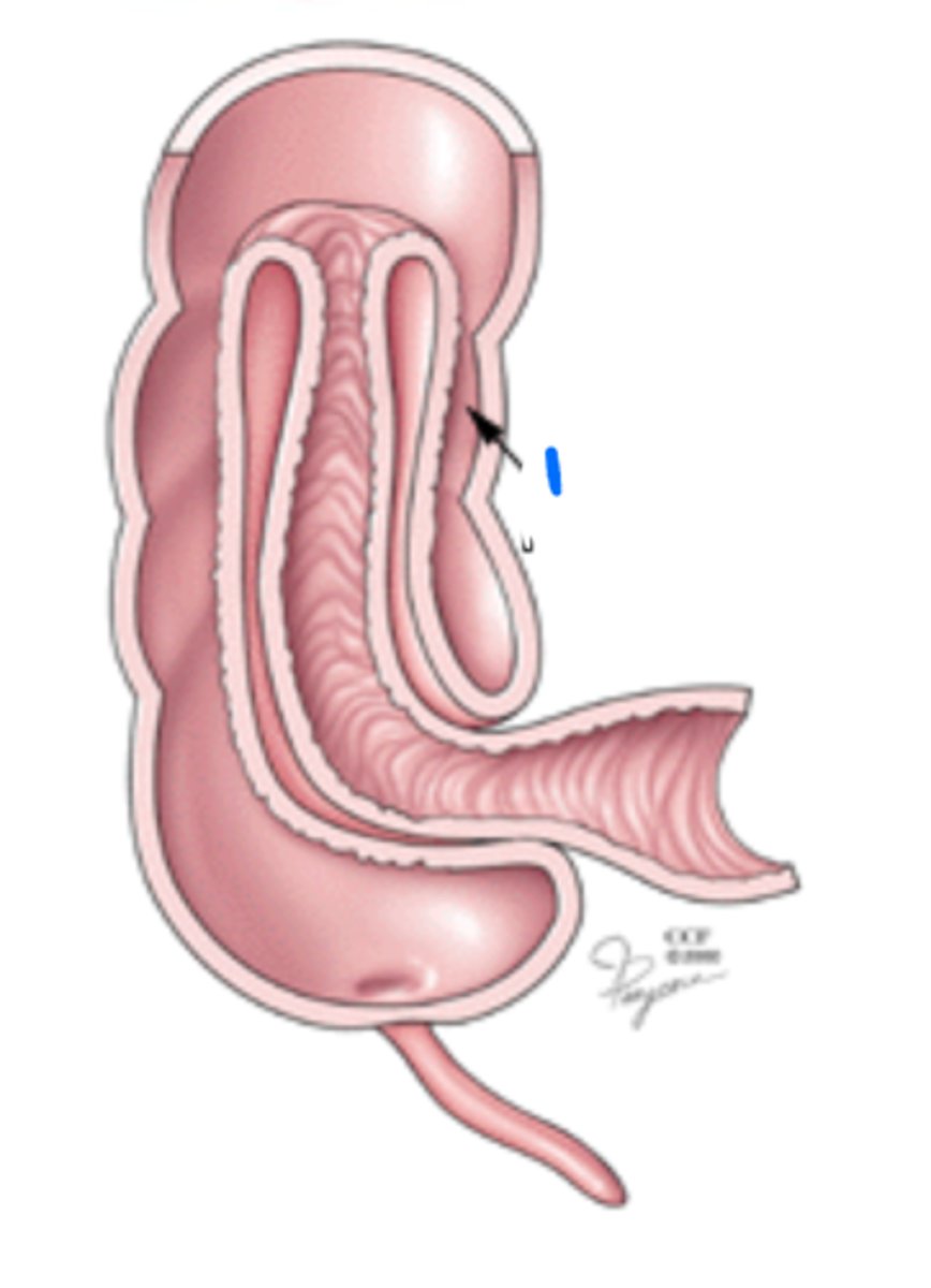 <p>Ileocecal valve dysfunction</p>