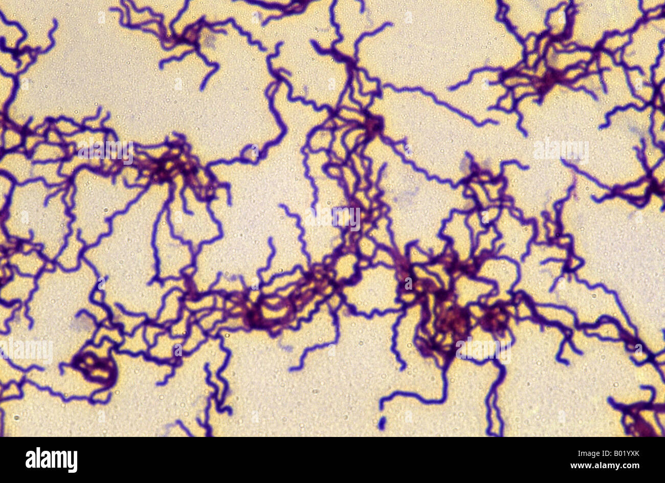 <p><span data-name="test_tube" data-type="emoji">š§Ŗ</span> <strong>Lab differentiation:</strong></p><ul><li><p><strong>Gram stain:</strong> Not reliable (too thin to visualize).</p></li><li><p><strong>Microscopy:</strong> Best seen with <strong>dark-field microscopy</strong> of lesion exudate, appearing as thin, tightly coiled spirochetes with corkscrew motility.</p></li><li><p><strong>Culture:</strong> Cannot be cultured on artificial media. Maintained in rabbit testes for research only.</p></li><li><p><strong>Tests:</strong> Serologic testing is standard. Non-treponemal tests (VDRL, RPR) detect antibodies against cardiolipin. Treponemal tests (FTA-ABS, TP-PA) confirm infection. PCR can also be used.</p></li></ul><p><span data-name="woman_health_worker" data-type="emoji">š©āā</span> <strong>Patient scenario:</strong><br>A 32-year-old man presents with a painless ulcer on his penis that appeared two weeks after unprotected sex. Dark-field microscopy of the lesion fluid reveals slender, spiraling organisms. VDRL is positive, confirming syphilis.</p><p><span data-name="clipboard" data-type="emoji">š</span> <strong>Details:</strong><br><strong>(A) Classification:</strong> Spirochete bacterium, too thin for Gram stain, visualized by dark-field or silver stains.<br><strong>(B) Disease:</strong> Causes <strong>syphilis</strong>, which progresses through stages:</p><ul><li><p>Primary: painless chancre.</p></li><li><p>Secondary: rash (including palms/soles), condylomata lata, fever.</p></li><li><p>Latent: asymptomatic.</p></li><li><p>Tertiary: gummas, cardiovascular syphilis, neurosyphilis.<br><strong>(C) Identification/Diagnosis:</strong> Dark-field microscopy of lesion, serologic screening (RPR/VDRL) followed by confirmatory treponemal tests (FTA-ABS).<br><strong>(D) Treatment/Prevention:</strong> Penicillin G is the treatment of choice for all stages; doxycycline can be used if allergic. Prevention: safe sex practices, routine screening in high-risk groups, prenatal testing to prevent congenital syphilis.<br><strong>(E) Unique Epidemiology & Lab Safety:</strong> Only infects humans; transmitted sexually, via blood, or congenitally. In lab, diagnosis relies on serology since culture isnāt possible. Specimens should be handled under <strong>BSL-2 conditions</strong> with caution due to infectious risk in lesion material.</p></li></ul><p></p>