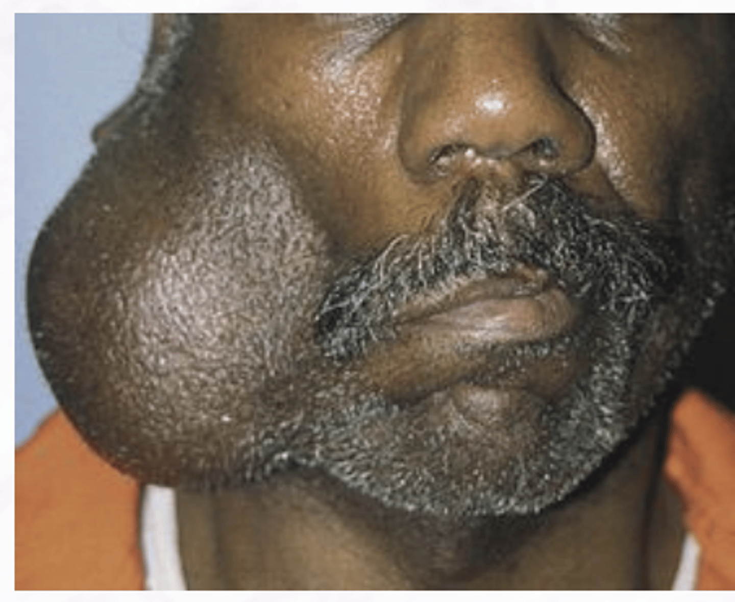 <p>Acinic Cell Carcinoma</p>
