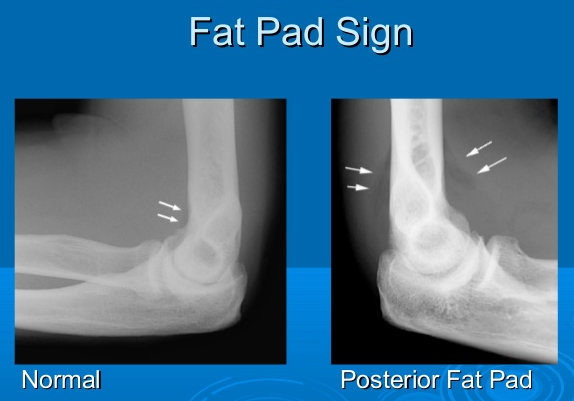 <ul><li><p><span>anterior fat pad, usually concealed within the coronoid fossa, becomes elevated and takes on a triangular shape</span></p></li><li><p><span>indicates joint effusion</span></p></li><li><p>In adults: sign of an occult fracture of the radial head</p></li><li><p>in children: supracondylar (distal humerus) fracture</p></li></ul><p></p>