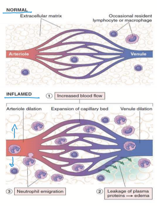 <p>Inflammatory mediator and LPS on Gram negative bacteria causes vasodialtion via NO. </p>