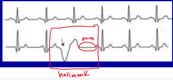 <p>What rhythm is likely present on the following ECG trace?</p>