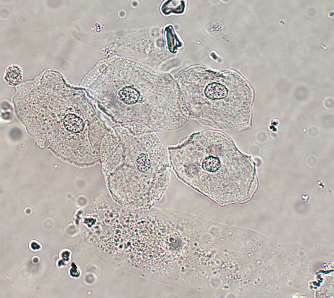 <p>Largest cells w/ abundant, irregular cytoplasm</p><ul><li><p>Represent normal cellular sloughing and have no pathological significance</p></li><li><p>Originate from linings of:</p><ul><li><p>Female: vagina + urethra</p></li><li><p>Male: lower urethra</p></li></ul></li></ul><p></p>