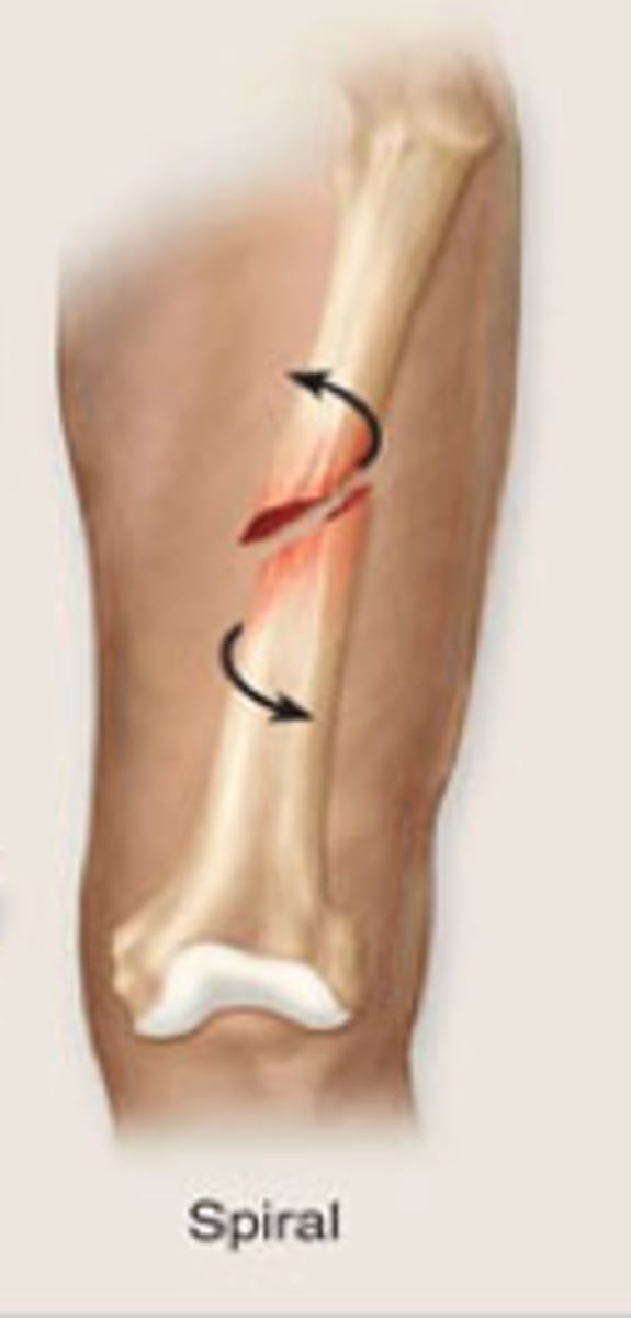 <p>ragged break occurs when excessive twisting forces are applied to a bone</p>
