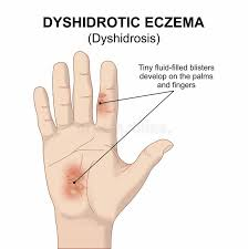 <p>PP: recurrent vesicular hand eczema<br>thick acral skin→edema→vesicles</p><p>E: stress<br>allergy<br>irritants</p><p>CM: firm+pruitic vesicles on palms (more common)+soles (less common) on medial/lateral aspects of digits<br>“tapioca pudding”</p><p>DX: rule out contact dermatitis</p><p>TX:<br><u>NP<br></u>pt education<br>repair skin barrier→prevent outbreaks<br>moisturizer after baths<br>decrease number+length+temperature of baths<br>allergen-free detergents<br>cotton clothing<br>humidifier<br><strong>no food restriction diet</strong><br><strong>severe→allergist referral</strong></p><p><u>MX</u></p><p><strong>mild-moderate:</strong><br><u>mild</u><br>topical hydrocortisone 2.5% BID x up to 2 weeks</p><p><u>moderate</u><br>topical triamcinolone 0.1% BID x up to 2 weeks</p><p>topical tacrolimus QD x up to 6 weeks<br>topical pimecrolimus QD x up to 6 weeks<br>topical ruxolitinib<br>cetirizine<br>hydroxyzine</p><p><u>infection</u><br>topical abx<br>PO abx</p><p><strong>moderate-severe:</strong><br><strong>1st line→SQ duplimab x 2-4 weeks</strong></p><p><strong>2nd line:</strong><br><strong>baricitinib</strong><br><strong>abrocitinib</strong><br><strong>upadacitinib</strong></p><p>PO prednisone<br>narrow band UVB x 3x/week<br>PO cyclosporine</p>