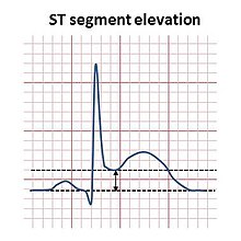<p>Myocardial infarction</p>