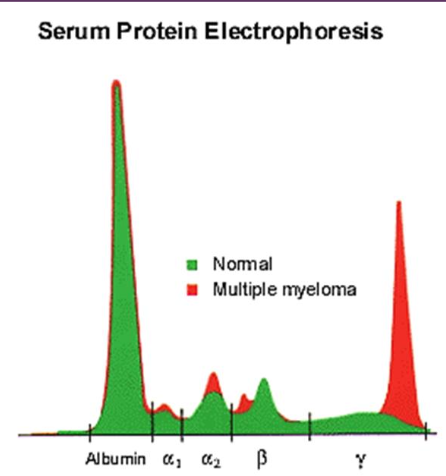 <p><span>-cytology of malignant site</span><br><span>-bone marrow aspirate (over 20% plasma cells in dogs, 10-20% in cats)</span><br><span>-serum protein electrophoresis (monoclonal gammapothy, occasionally biclonal)</span><br><span>-bence jones proteinuria (monoclonal light chains in urine- not detected on typical UA)</span><br><span>-immunoglobulin quantification and PCR</span></p>