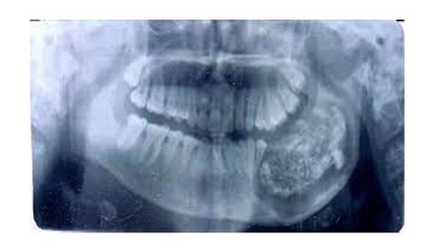 <p>An odontoma that does not resemble teeth, usually located in the posterior mandible.</p>