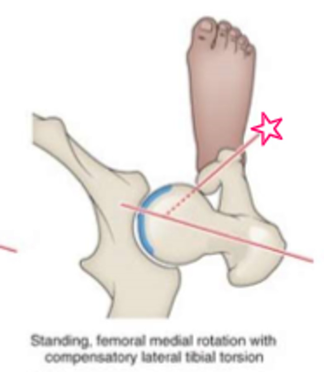 <p>Anteversion of the hip resulting in a toe in gait to improve hip joint congruency, and then lateral tibial torsion to eliminate toe it - femoral condyles remain in ________________ ________________.</p>