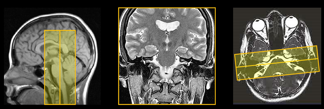 <p>Coronal slice coverage for IAC </p>