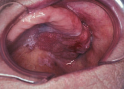 <p>term used as a <span style="color: red;">clinical diagnosis</span>,<span style="color: red;"> not</span> a histologic one, similar to oral leukoplakia</p><p><span style="color: red;">bright red, velvety plaques</span> which cannot be characterized clinically or pathologically as being due to any other condition as per WHO (1978)</p><ul><li><p><strong>clinical significance</strong></p><ul><li><p>studies show that <strong>90% of lesions</strong> clinically diagnosed as erythroplakia are either premalignant or malignant</p></li></ul></li><li><p><strong>treatment:</strong></p><ul><li><p><span style="color: red;">biopsies</span> to confirm or rule out the presence of premalignancy or malignancy</p></li></ul></li></ul><p></p>