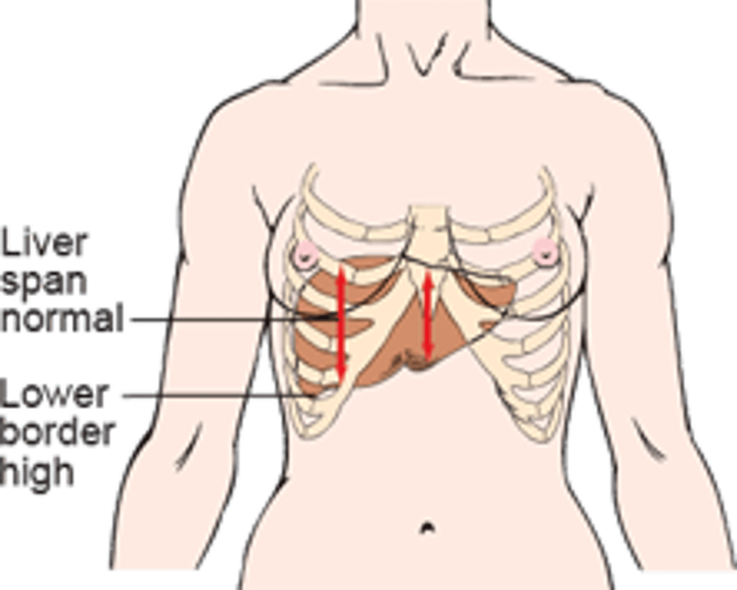 <p>may be caused by an abdominal mass, ascites, or a paralyzed diaphragm</p>