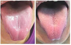<p>smooth+sore tongue</p><p>no papillae</p>