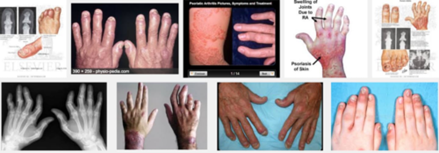 <p>- generalized fatigue</p><p>- TTP, pain, swelling</p><p>- swollen fingers/toes</p><p>- stiff, pain, throbbing</p><p>- decreased ROM</p><p>- morning stiff/tired</p><p>- nail changes***</p><p>- conjunctivitis</p>