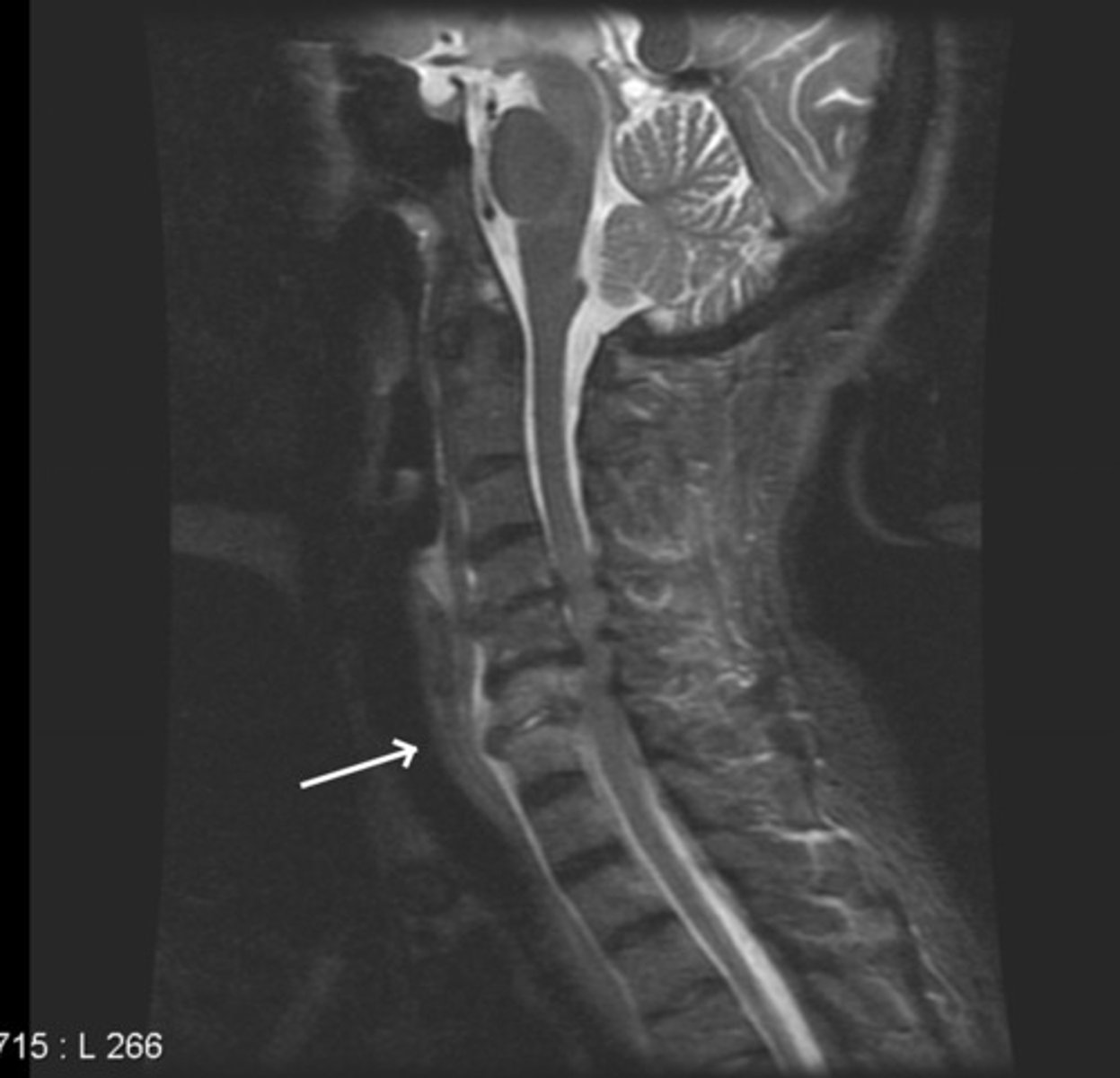 <p>XR: Early findings normal, later see demineralization</p><p>CT: Localize abscess</p><p>MRI: Most specific</p>