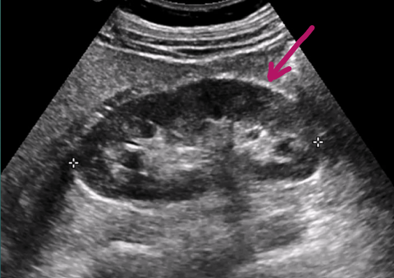 <p>Appears as a strong continuous linear, echogenic reflector surrounding the renal cortex</p>