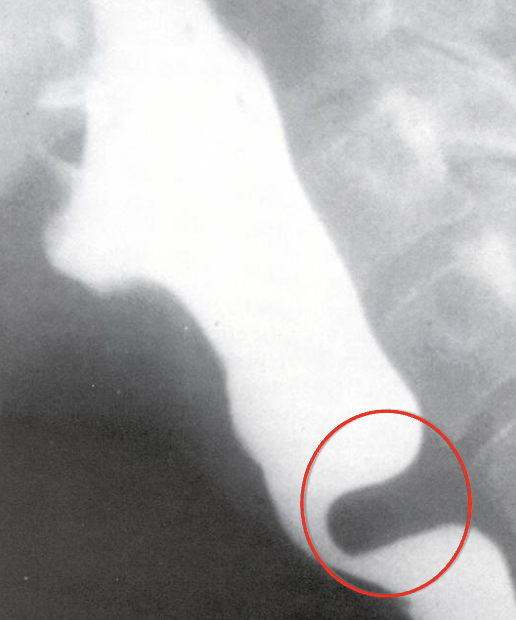<p>What esophageal disorder is this?</p>
