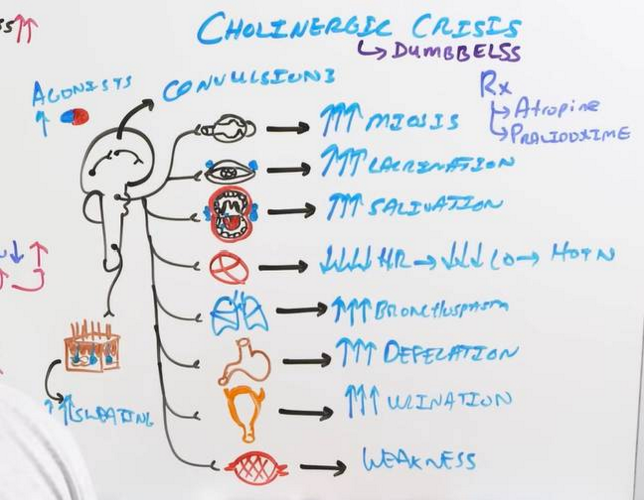 <p>Caused by:</p><ul><li><p>Neostigmine or Pyridostigmine</p></li><li><p>Too much ACh because AChE is overly inhibited!</p></li></ul><p>DUMBBELSS</p><ul><li><p>Digestion/Diarrhea</p></li><li><p>Urination</p></li><li><p>Miosis</p></li><li><p>Bradycardia</p></li><li><p>Bronchoconstriction </p></li><li><p>Emesis</p></li><li><p>Lacrimation</p></li><li><p>Salivation</p></li><li><p>Sweating</p></li></ul><p>Tx:</p><ul><li><p>Atropine (muscarinic antagonist, prevents ACh overload)</p></li><li><p>Pralidoxime (AChE regenerator, restores nicotinic function)</p></li></ul><p></p>