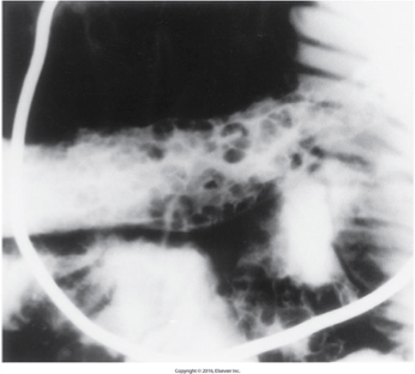 <p>What is Crohn's Disease (Regional Enteritis) ?</p>