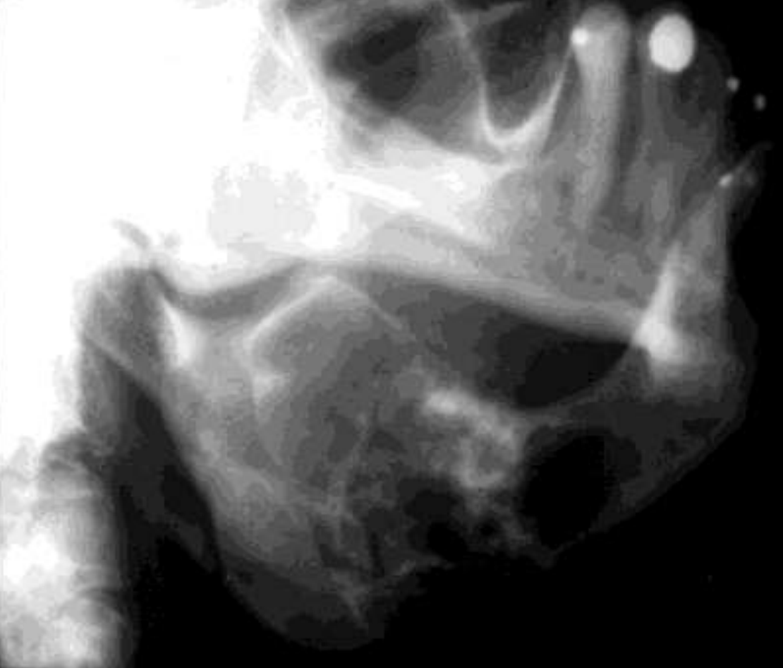 <ul><li><p>Variable margins</p><ul><li><p>Well defined or poorly defined</p></li></ul></li><li><p>Radiolucent</p></li><li><p>Multilocular</p><ul><li><p>Few straight septae</p></li><li><p>Curved septae seen as well</p></li></ul></li><li><p>Expansile- expands cortical margins</p></li><li><p>Tooth displacement</p></li></ul><p></p><p></p>