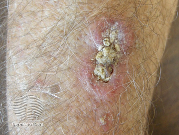<p>SCC </p>