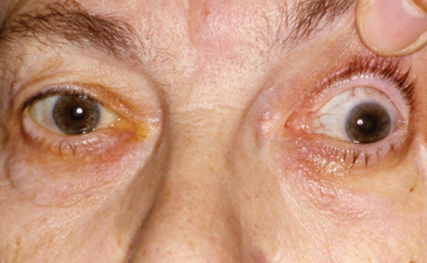 <p>What 3/3 etiology with the nerve causing a large pupil is shown here?</p>