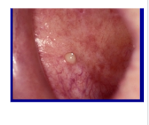<p>Infection from mouth to parotid duct → then to gland</p><p>S.aureus causes it</p><p>Pain, swelling, pus in duct</p><p>Secondary to dry mouth → which is caused by radiotherapy, Sjogren, drug induced xerostomia</p>