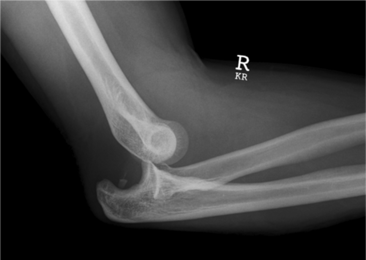 <p>Majority of posterior dislocations - FOOSH injury</p>