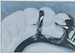 <p>Transfers forces from indirect retainers / auxiliary rests to the major connector</p><p>Used when indirect retention or extra support (auxiliary rests) is needed to prevent denture rotation</p>
